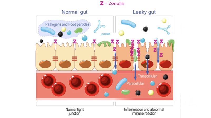 New 2025 Study: High Zonulin Tracks Autism Severity – How to reduce&nbsp;it